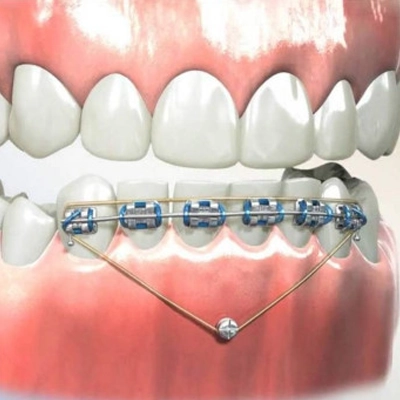 Getting Invisalign Invisalign in Greenville